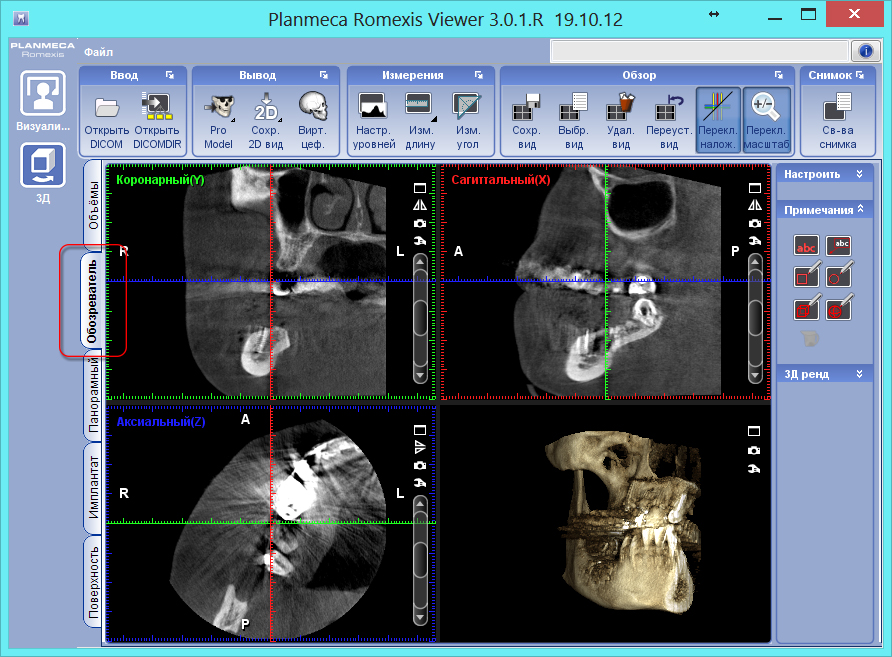Просмотр снимка в 3-х проекциях. Planmeca Romexis Viewer Просмотр снимка в 3-х проекциях. Planmeca Romexis Viewer
