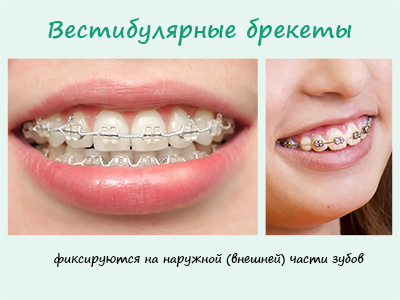 Вестибулярные брекет-системы устанавливаются на наружной (внешней) части зубов Вестибулярные брекет-системы устанавливаются на наружной (внешней) части зубов