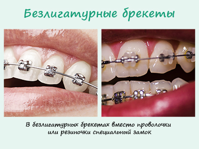 В безлигатурных брекет-системах проволочка или резиночка отсутствует и брекет крепится к дуге при помощи специального замка. В безлигатурных брекет-системах проволочка или резиночка отсутствует и брекет крепится к дуге при помощи специального замка.
