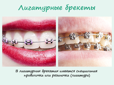 В лигатурных брекет-системах имеется специальная проволочка или резиночка (лигатура), которая прижимает брекет к дуге. В лигатурных брекет-системах имеется специальная проволочка или резиночка (лигатура), которая прижимает брекет к дуге.